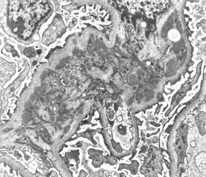 M,21y. | IgA nephropathy (Berger disease) M,21y. | IgA nephropathy (Berger disease)